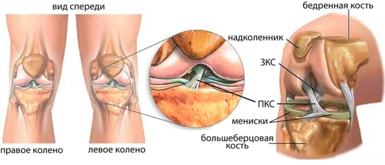 Как лечить разрывы, надрывы, растяжения крестообразных связок